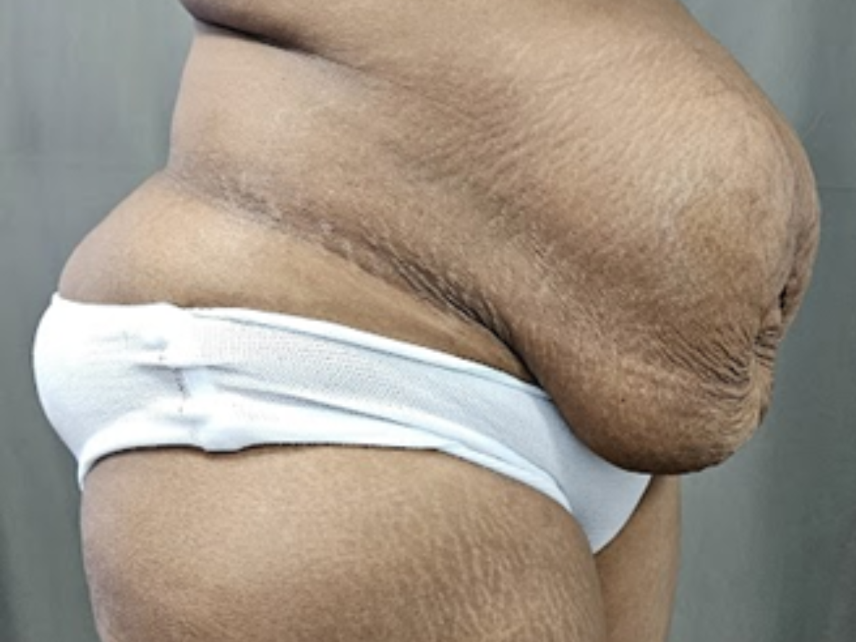 Tummy Tuck Results